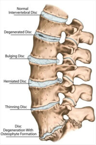How can Ayurvedic treatments for cervical spondylosis help avoid surgery? cervical spondylosis