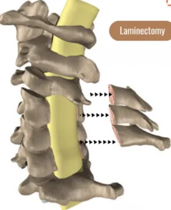 How can Ayurvedic treatments for cervical spondylosis help avoid surgery? cervical spondylosis