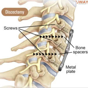 How can Ayurvedic treatments for cervical spondylosis help avoid surgery? cervical spondylosis