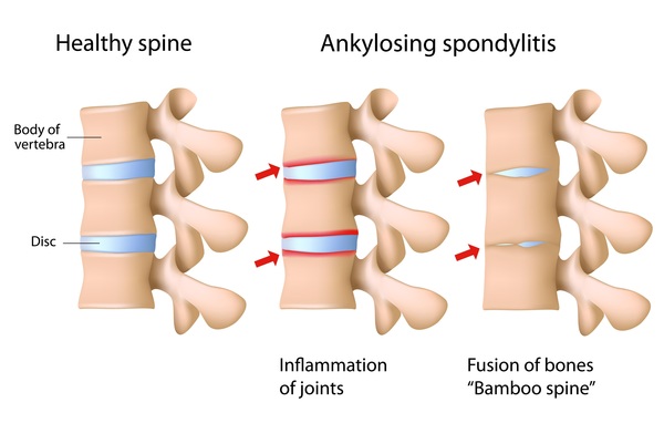 Ayurvedic Management of Ankylosing Spondylitis: The holistic way Ayurvedic Management of Ankylosing Spondylitis