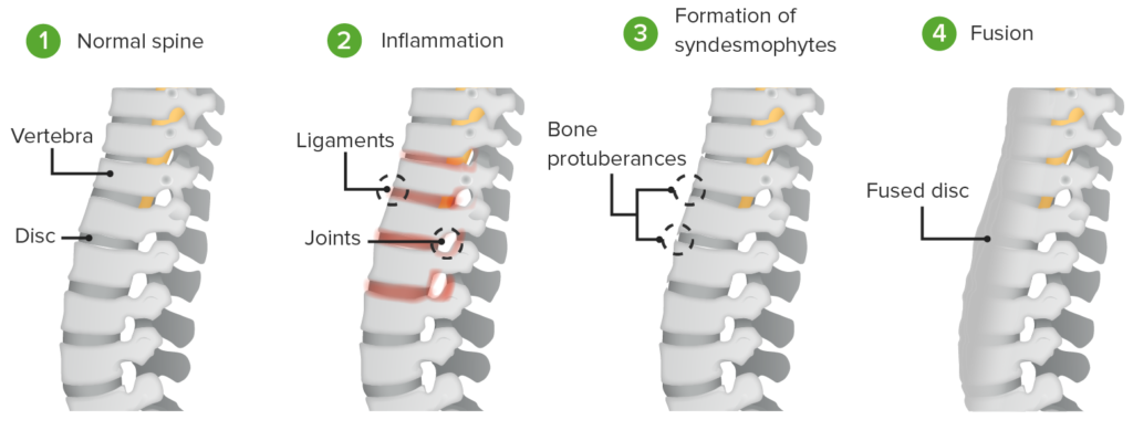 Ayurvedic Management of Ankylosing Spondylitis: The holistic way Ayurvedic Management of Ankylosing Spondylitis