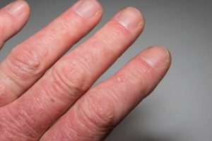 Ayurvedic treatment for Arthritis Ayurveda treatment for rheumatoid arthritis, Psoriatic arthritis