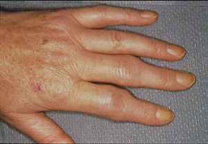 Ayurvedic treatment for Arthritis Ayurveda treatment for rheumatoid arthritis