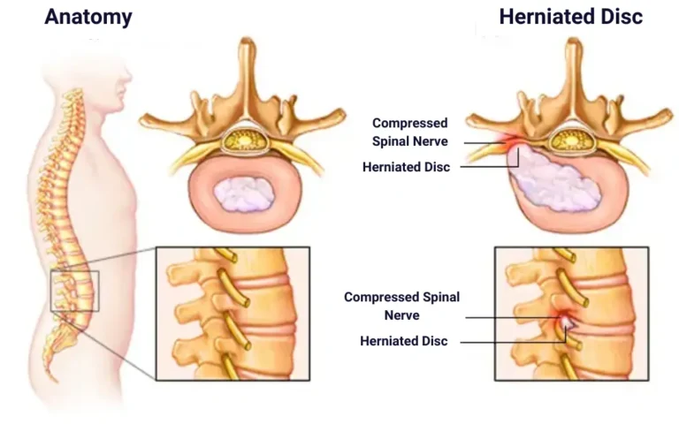 Ayurvedic treatment for Herniated Disc symptoms of herniated disc , herniated disc