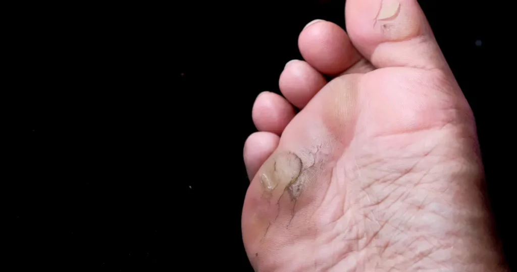 Ayurvedic treatment for Diabetes Ayurveda Treatment for Diabetes, types of diabetes, signs and symptoms of diabetes