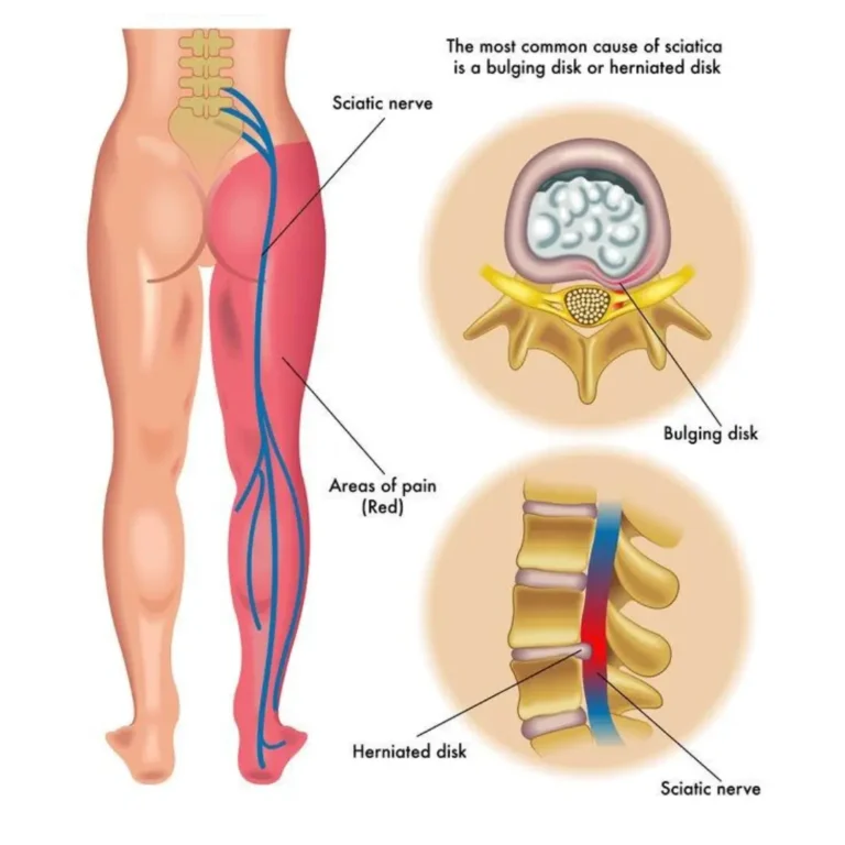 Ayurvedic treatment for Sciatica ayurveda treatment for sciatica, sciatica symptoms