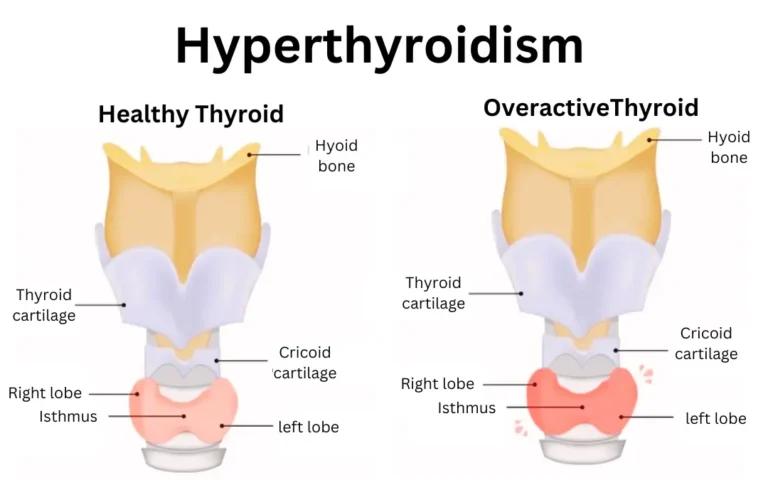 Ayurveda treatment for thyroid