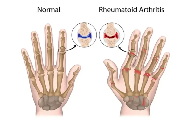 Ayurvedic treatment for Rheumatoid Arthritis Ayurveda treatment for Rheumatoid arthritis