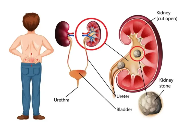 Preventing Kidney Stones from Reoccurring: Causes, Allopathic Approaches, and Ayurvedic Solutions Preventing Kidney Stones from Reoccurring