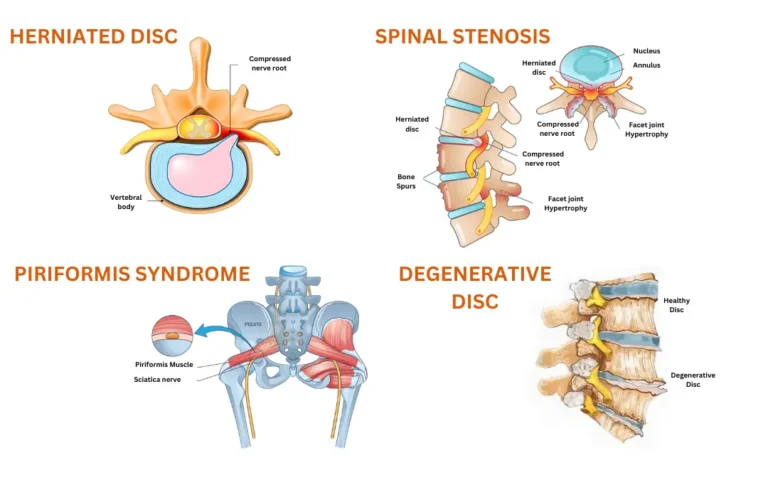Sciatica Nerve Treatment in Ayurveda