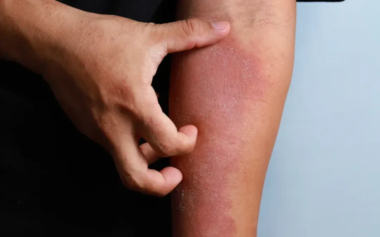 ayurvedic treatment for eczema