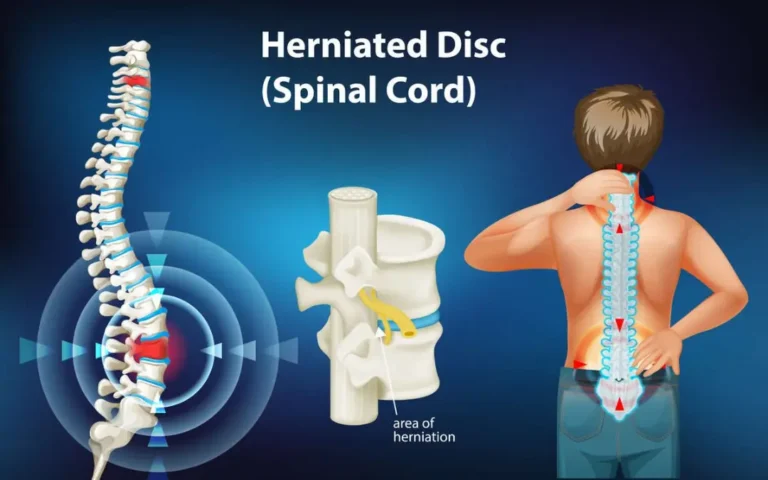 Understanding and Treating Herniated Lumbar Disc: Allopathy vs. Ayurveda Ayurvedic doctor discussing herniated lumbar disc treatments.