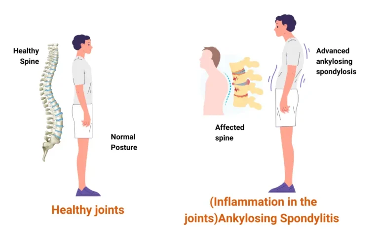 Ayurvedic treatment for Ankylosing spondylitis Ayurvedic treatment for Ankylosing Spondylitis