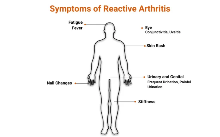 Ayurvedic treatment for Reactive Arthritis Ayurvedic treatment for Reactive Arthritis