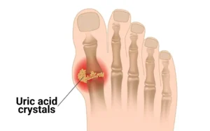 What is Uric Acid and Why Should You Care?