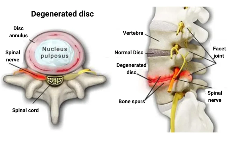 Ayurvedic treatment for Degenerative disk diseases (DDD) slipped disc symptoms, slipped disc ayurvedic treatment, Ayurvedic treatment for Degenerative disc disease