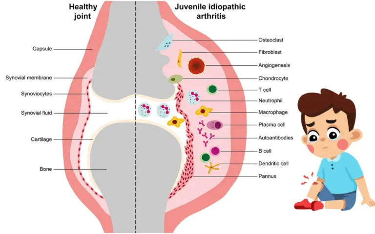 Ayurvedic treatment for Juvenile idiopathic Arthritis Ayurvedic Treatment for Juvenile Idiopathic Arthritis
