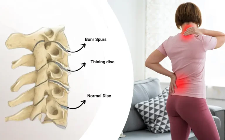 Ayurvedic treatment for Lumbosacral spondylosis Ayurveda Treatment for Lumbosacral Spondylosis