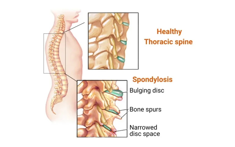 Ayurvedic treatment for Thoracic Spondylosis Ayurvedic Treatment for Thoracic Spondylosis