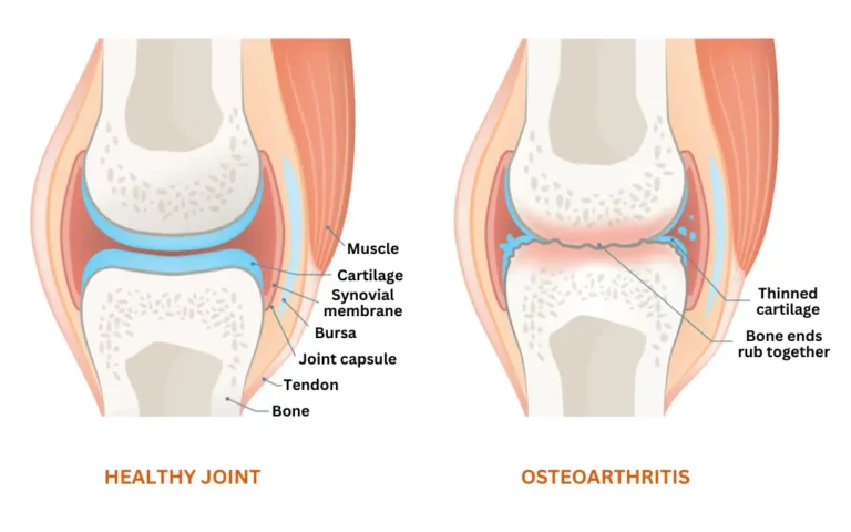 Ayurveda Treatment for Osteoarthritis at UWAY