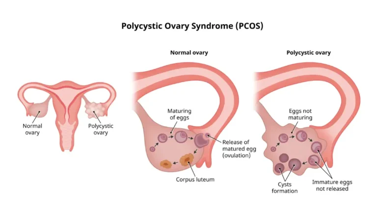 Ayurvedic treatment for PCOS