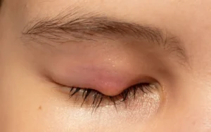 Ayurvedic treatment for Abscess Management ayurveda treatment for abscess management