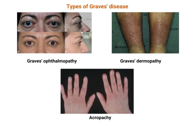 Ayurvedic treatment for Graves’ disease ayurveda treatment for graves' diseases