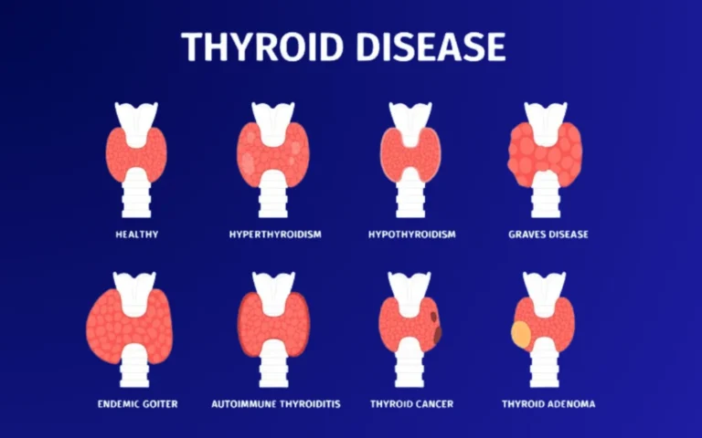 Types of Hyperthyroidism