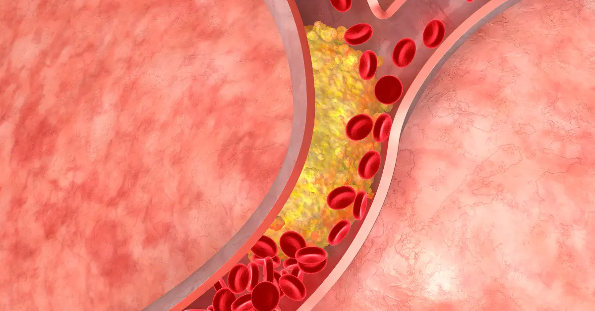 Revolutionize Your Heart Health: Dr. Kesavan Nambisan’s Proven Ayurvedic Approach to Balancing Triglycerides