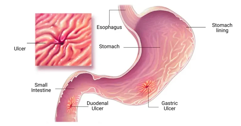 Ayurvedic treatment for Gastric Ulcers ayurvedic treatment for stomach ulcer