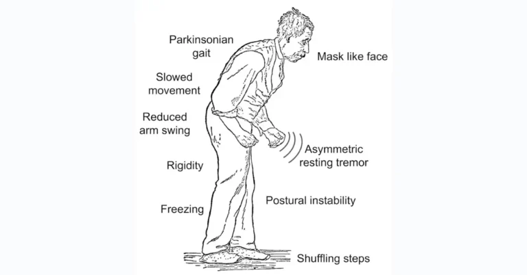 Ayurvedic treatment for Parkinson’s Disease Parkinsons Disease Treatment: A Holistic Approach with Ayurveda