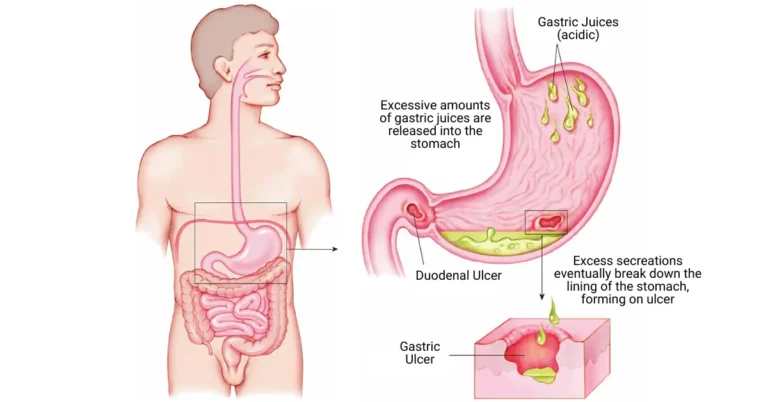 Ayurvedic treatment for Peptic Ulcers Ayurvedic treatment for peptic ulcer