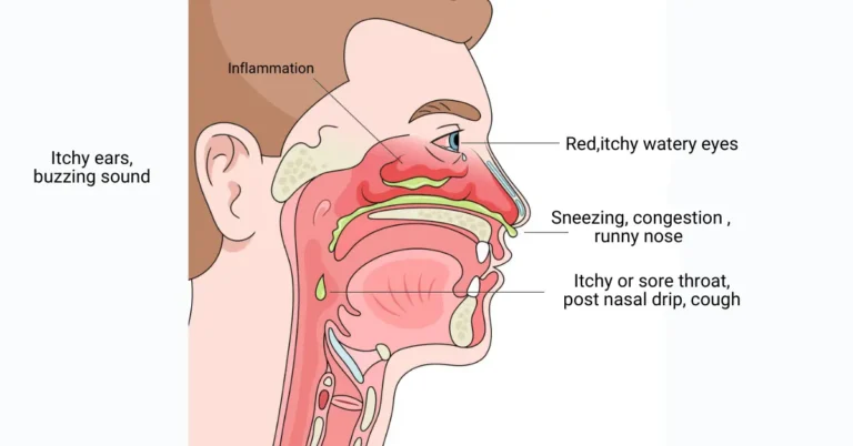 Ayurvedic treatment for Chronic Rhinitis how to treat rhinitis Ayurvedic remedies for rhinitis allergic rhinitis treatment Ayurvedic treatment for nasal allergy chronic nasal congestion relief natural rhinitis treatment rhinitis symptoms and cure Ayurveda for rhinitis relief Pratishyaya Ayurvedic treatment