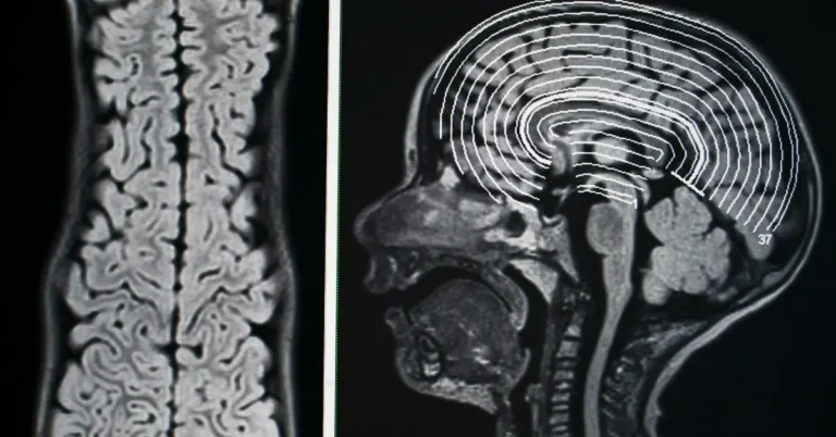 Ayurvedic treatment for Epilepsy Ayurveda Treatment for Epilepsy