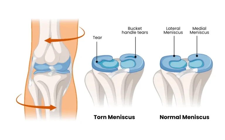 Why So Many Meniscus Injuries End Up at Our Ayurveda Clinic — And What We Do Differently Why So Many Meniscus Injuries End Up at Our Ayurveda Clinic — And What We Do Differently