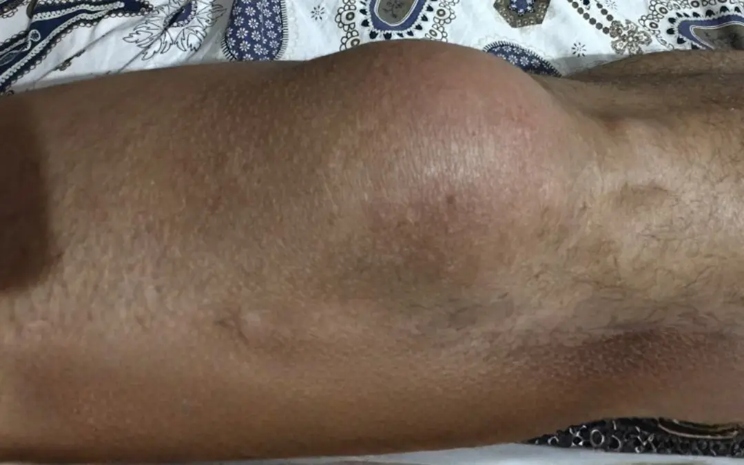 Can Ayurveda help in gout?